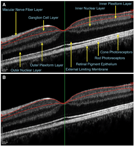 Optical Coherence Tomography (OCT)