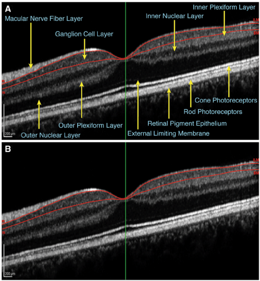Optical Coherence Tomography (OCT) – Sea to Sky Optometry