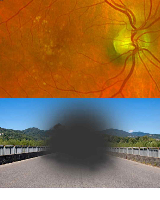 MacuMira for Macular Degeneration